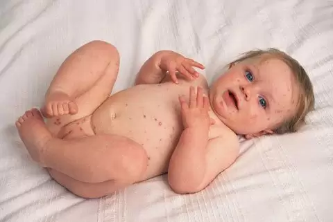 علاج جدري الماء عند الرضع بالاعشاب