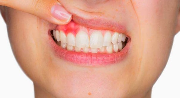 طرق علاج التهاب اللثة بالاعشاب