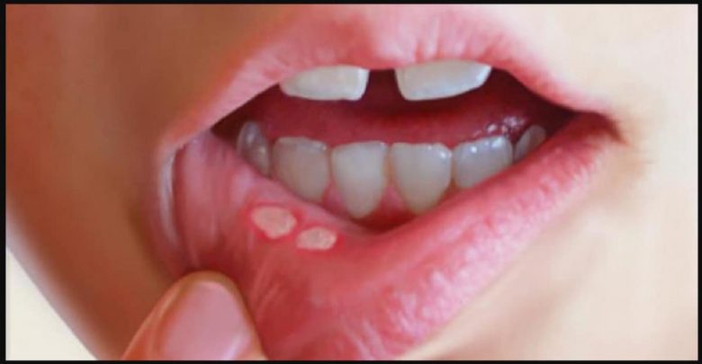 طرق علاج تقرحات الفم بالاعشاب 2024