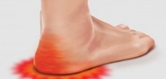 طرق علاج أملاح القدم وأسباب حدوث أنتفاخ للقدمين