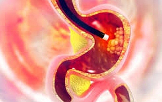 جاستروتدين لعلاج قرحة المعدة وارتجاع المرئ GASTROTIDINE