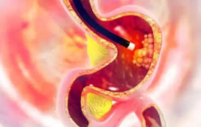 جاستروتدين لعلاج قرحة المعدة وارتجاع المرئ GASTROTIDINE