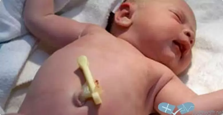 علاج فتق السرة للرضع بالاعشاب