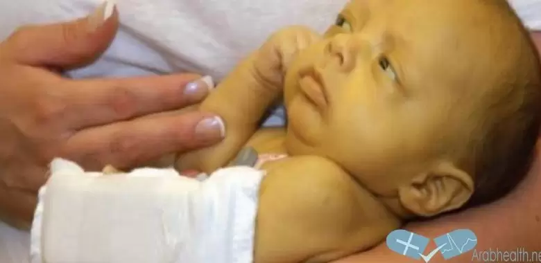 علاج أبو صفار عند حديثي الولادة