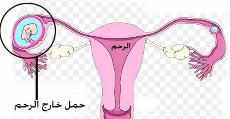 طرق معرفة الحمل خارج الرحم وعلاجه