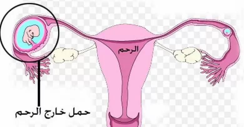 طرق معرفة الحمل خارج الرحم وعلاجه
