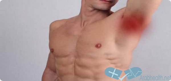 علاج التهاب الغدد الليمفاوية تحت الابط بالاعشاب