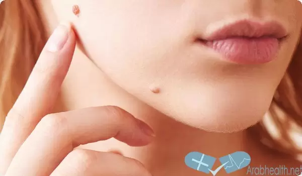 ماهو الفرق بين الزوائد الجلدية والثآليل