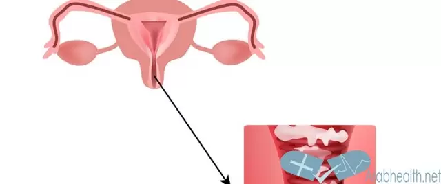 أعراض وأسباب التهابات المهبل