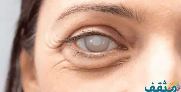 تفسير رؤية العين البيضاء في المنام
