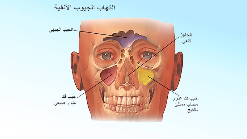 طرق تخفيف اعراض التهاب الجيوب الأنفية بسرعة