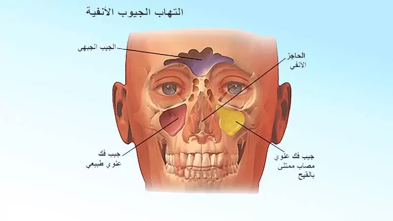 طرق تخفيف اعراض التهاب الجيوب الأنفية بسرعة