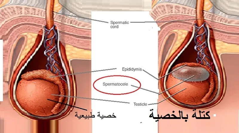 التهاب البربخ المزمن الأسباب والأعراض وطرق العلاج