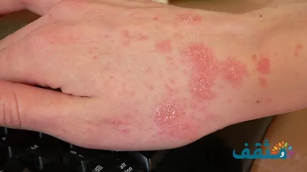 الفرق بين الجرب والحساسية