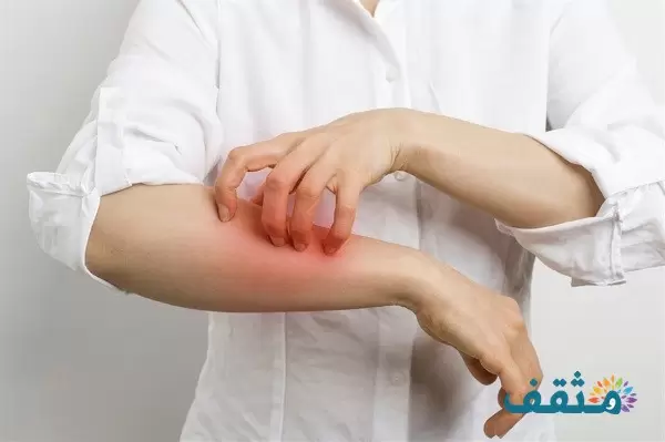 الفرق بين الجرب والحساسية